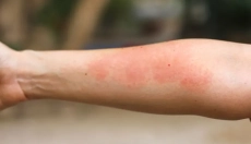 Co způsobuje kožní plíseň a jak se jí vyhnout?